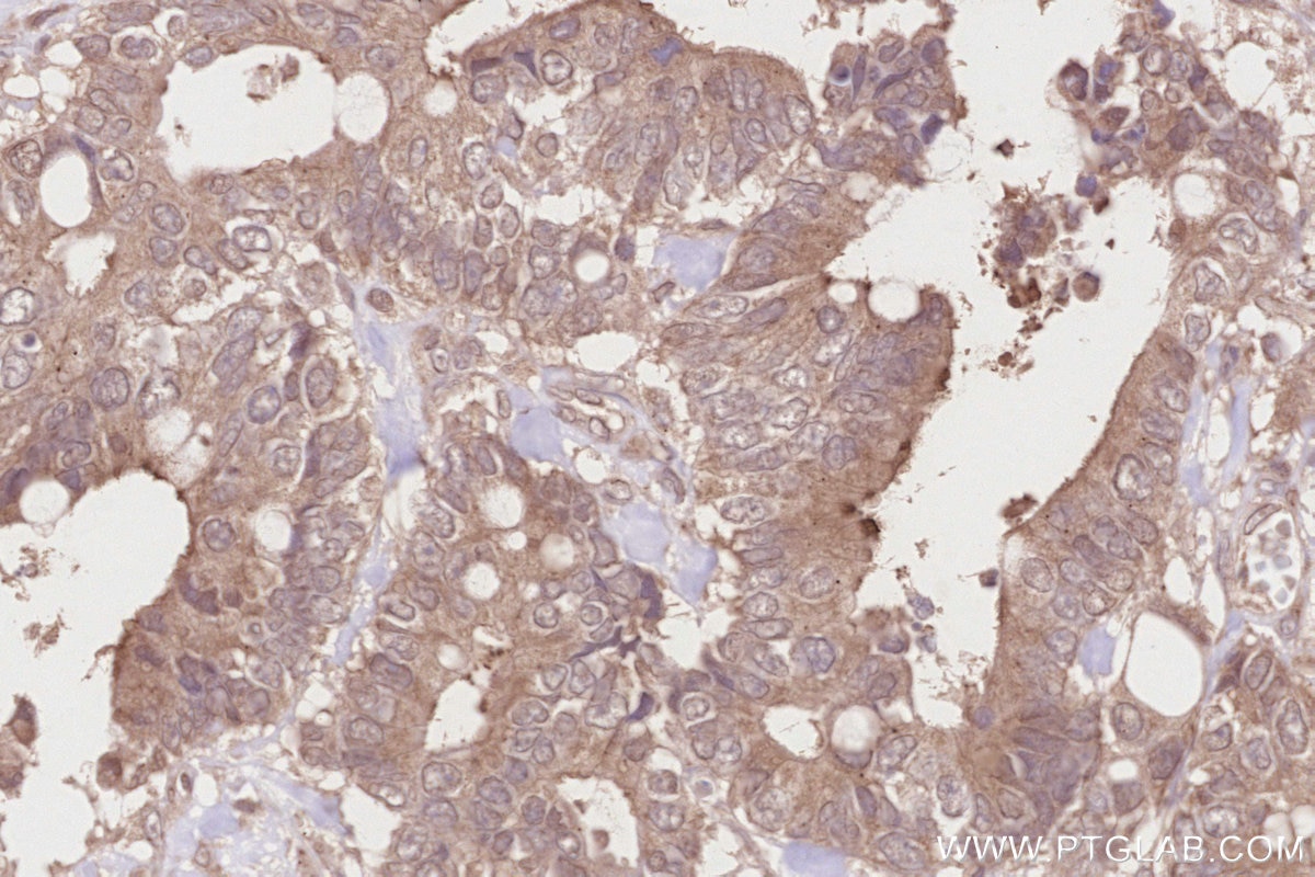 Immunohistochemistry (IHC) staining of human rectal cancer tissue using TUBGCP5 Polyclonal antibody (14620-1-AP)