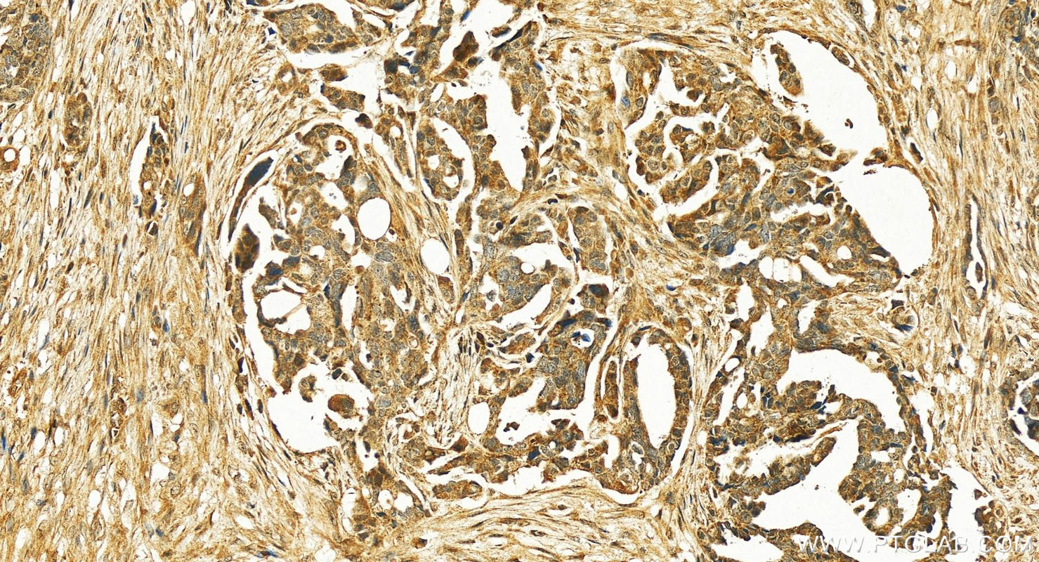 Immunohistochemistry (IHC) staining of human ovary cancer tissue using TULP3 Polyclonal antibody (13637-1-AP)