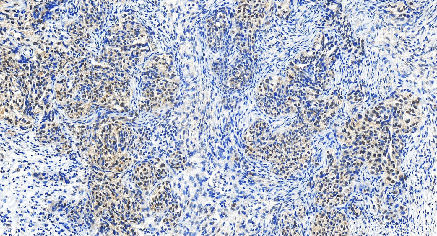 Immunohistochemistry (IHC) staining of human ovary cancer tissue using TWISTNB Polyclonal antibody (22784-1-AP)