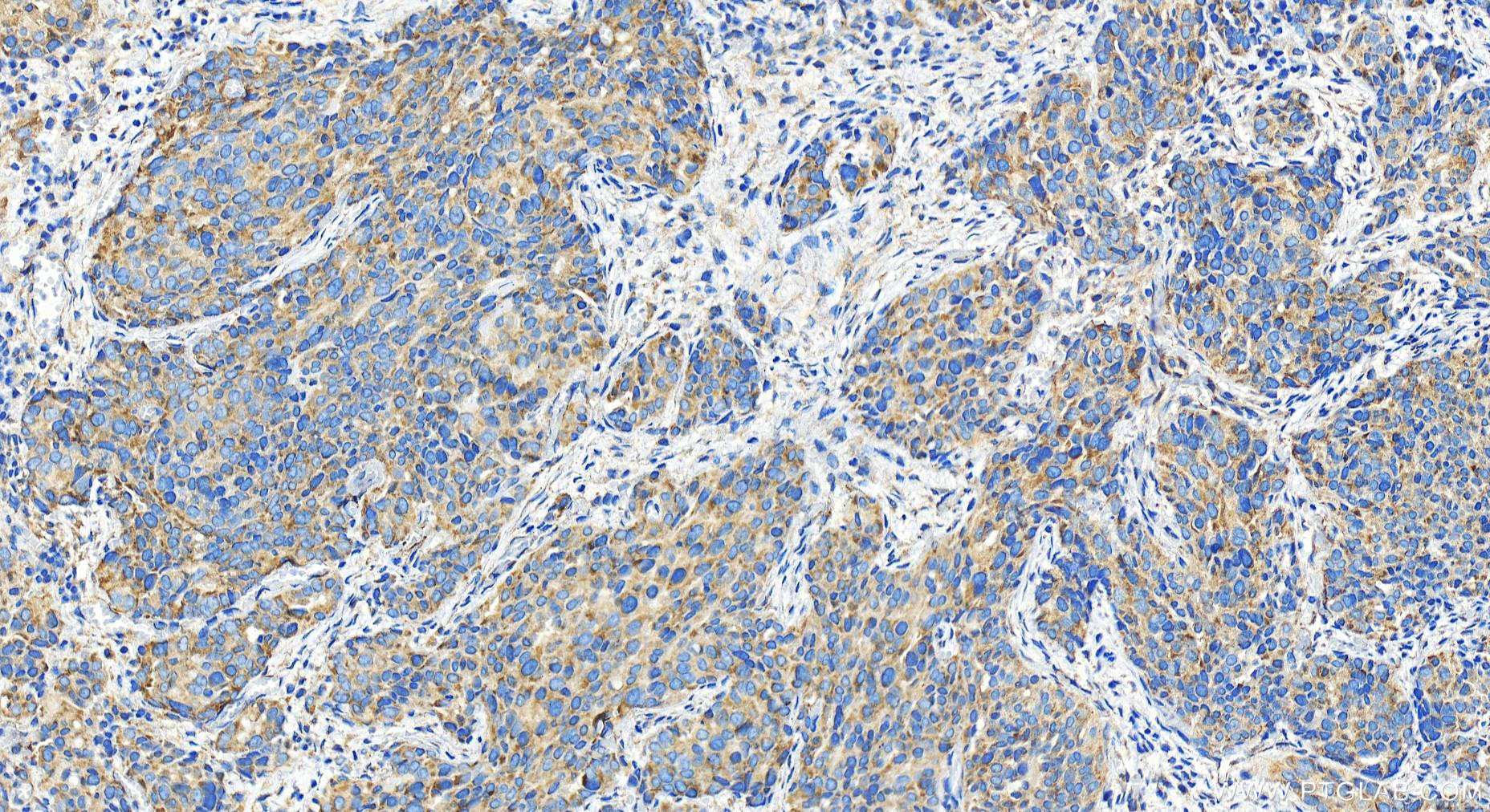 Immunohistochemistry (IHC) staining of human ovary cancer tissue using Alpha Taxilin Polyclonal antibody (27558-1-AP)