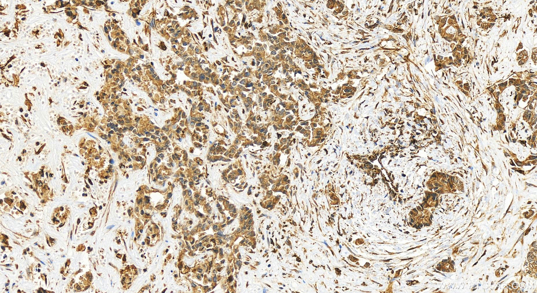 Immunohistochemistry (IHC) staining of human intrahepatic cholangiocarcinoma tissue using TXNDC11 Polyclonal antibody (25687-1-AP)