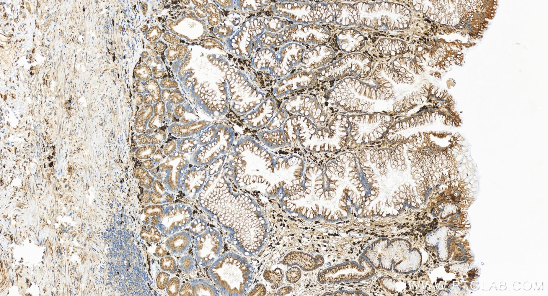 Immunohistochemistry (IHC) staining of human stomach cancer tissue using TXNDC5 Recombinant antibody (84756-5-RR)