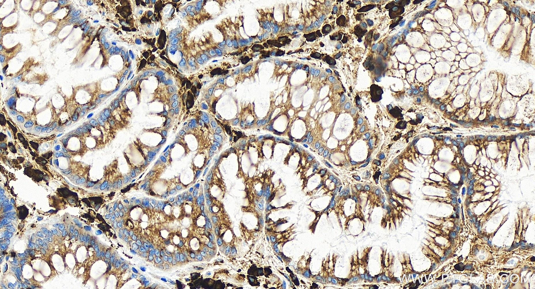 Immunohistochemistry (IHC) staining of human stomach cancer tissue using TXNDC5 Recombinant antibody (84756-5-RR)