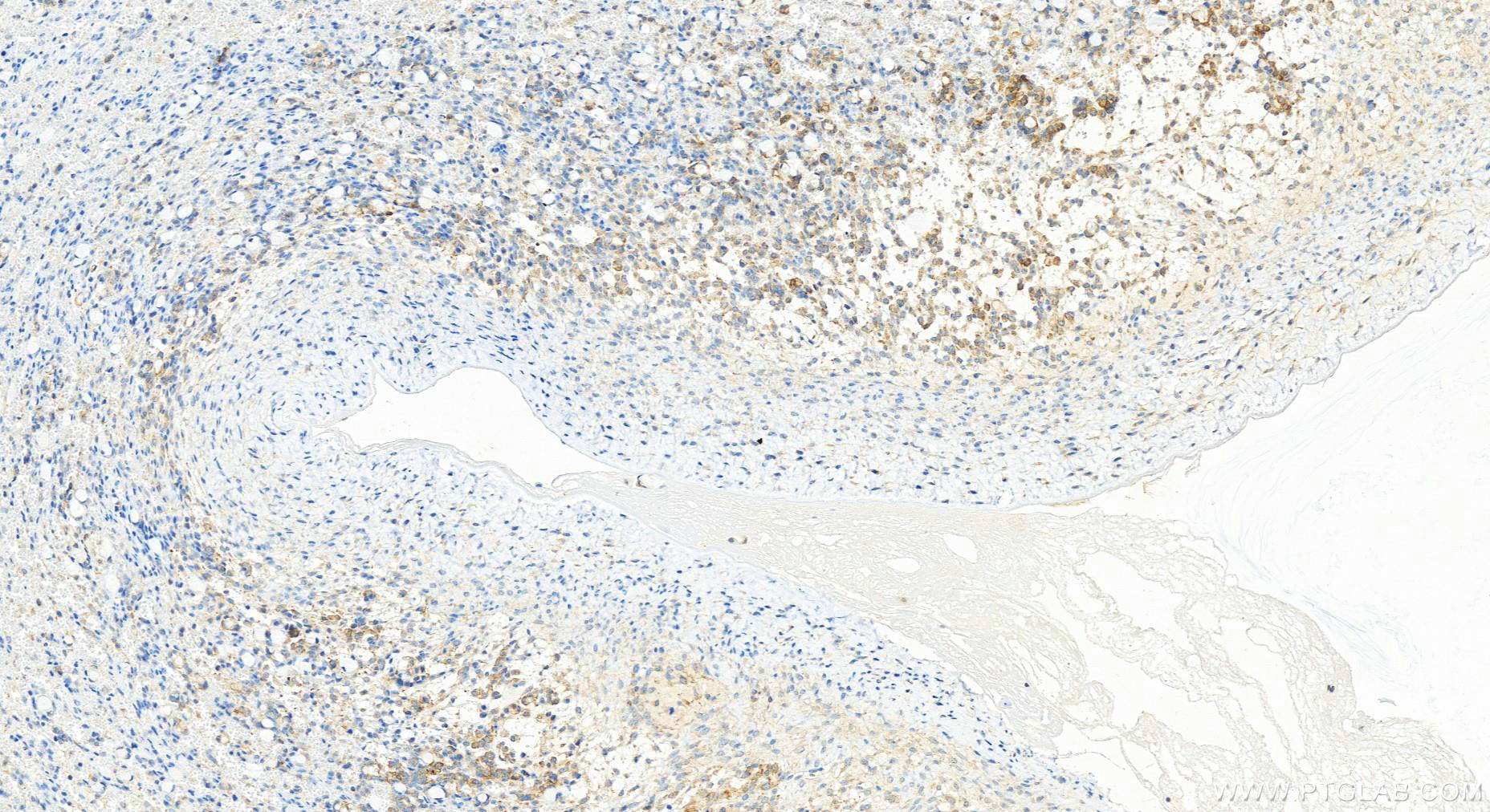 Immunohistochemistry (IHC) staining of human ovary cancer tissue using TYK2 Recombinant antibody (83161-4-RR)