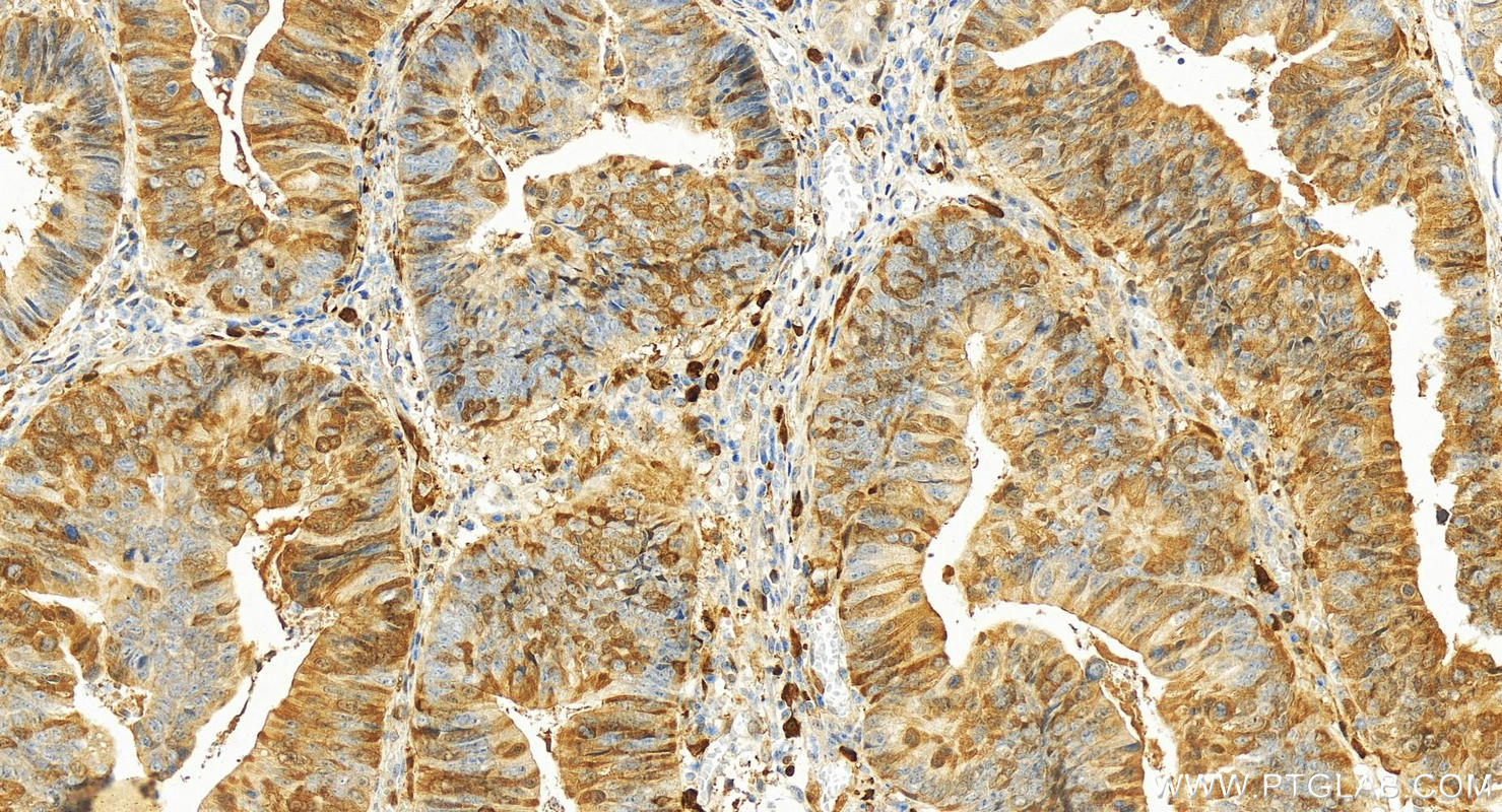 Immunohistochemistry (IHC) staining of human colon cancer tissue using Thymidylate synthase Polyclonal antibody (15047-1-AP)