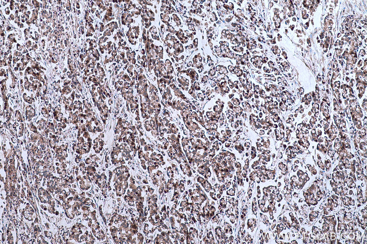 Immunohistochemistry (IHC) staining of human colon cancer tissue using TYMS Monoclonal antibody (66725-1-Ig)