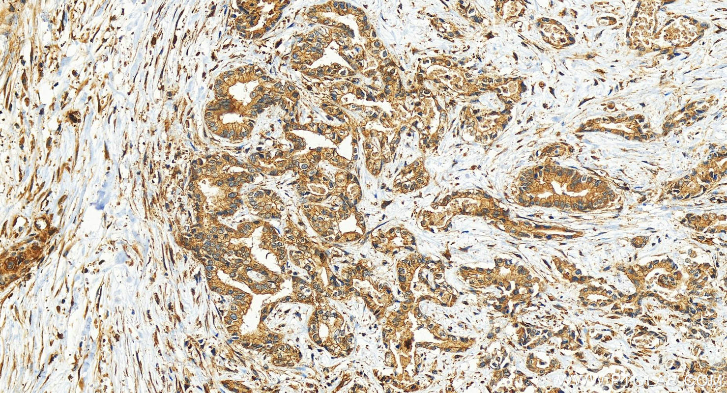 Immunohistochemistry (IHC) staining of human intrahepatic cholangiocarcinoma tissue using Talin-1 Recombinant antibody (82856-18-RR)