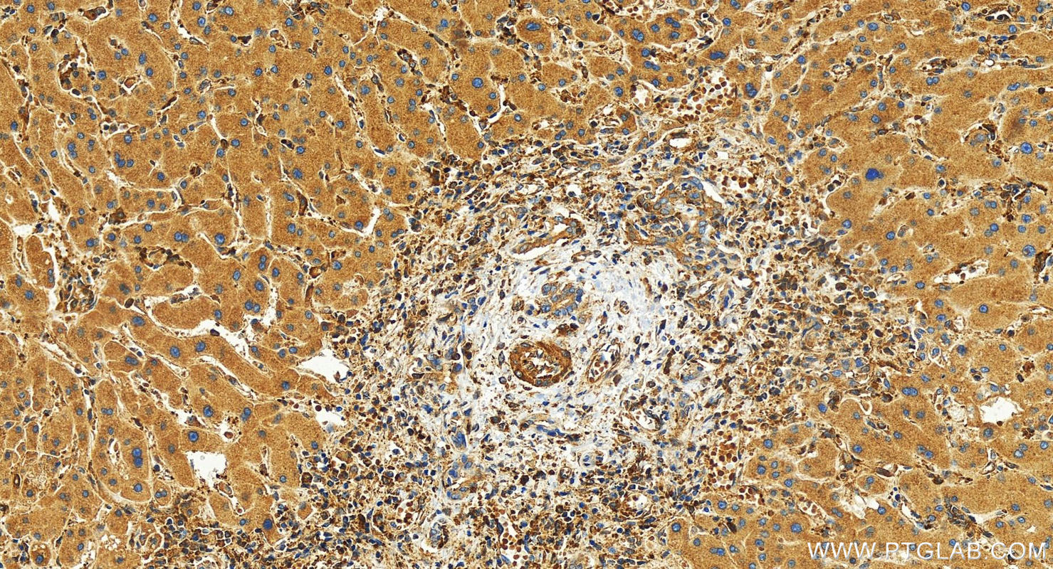 Immunohistochemistry (IHC) staining of human intrahepatic cholangiocarcinoma tissue using Talin-1 Recombinant antibody (82856-18-RR)