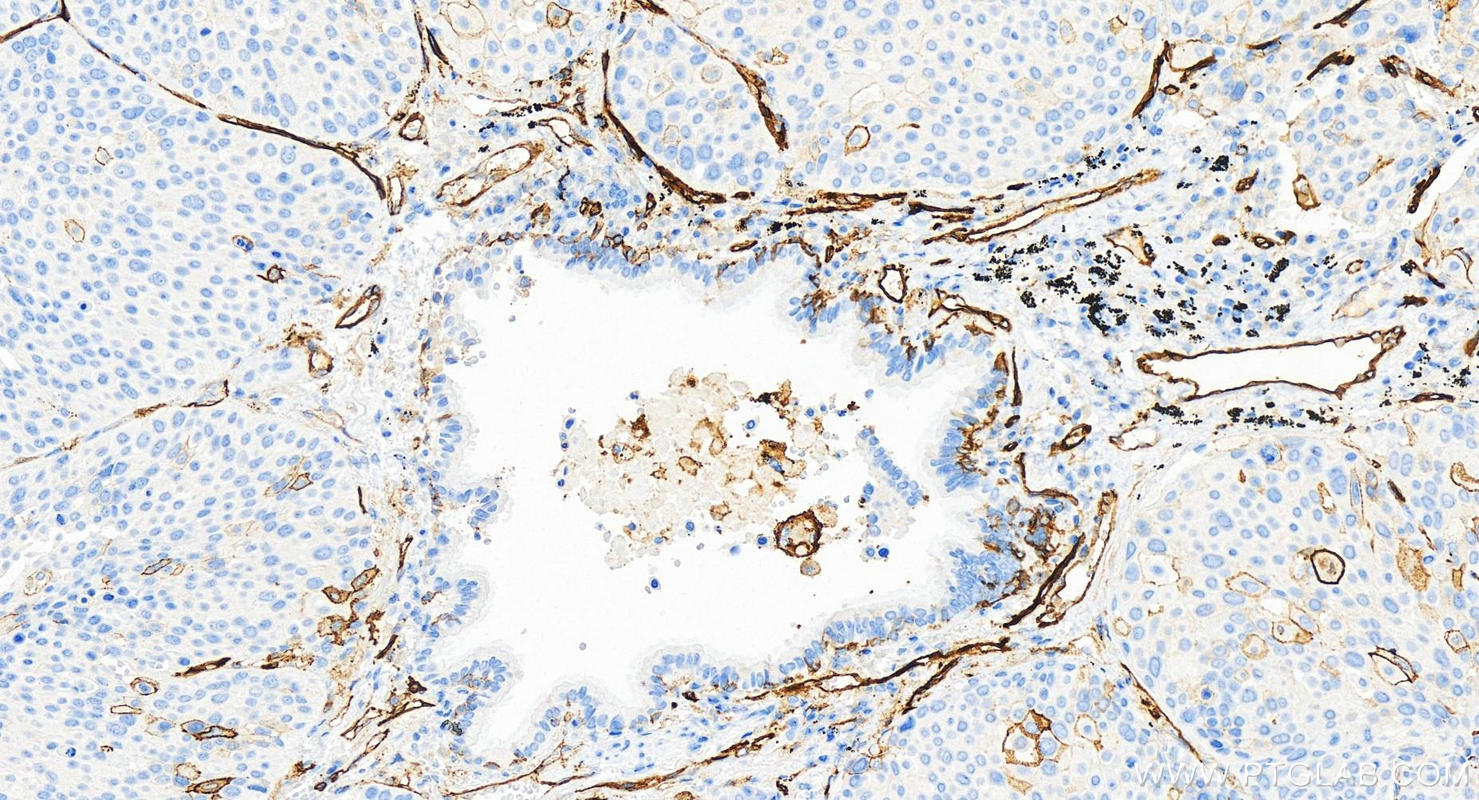 Immunohistochemistry (IHC) staining of human lung squamous cell carcinoma tissue using CD141/Thrombomodulin Recombinant antibody (83416-4-RR)