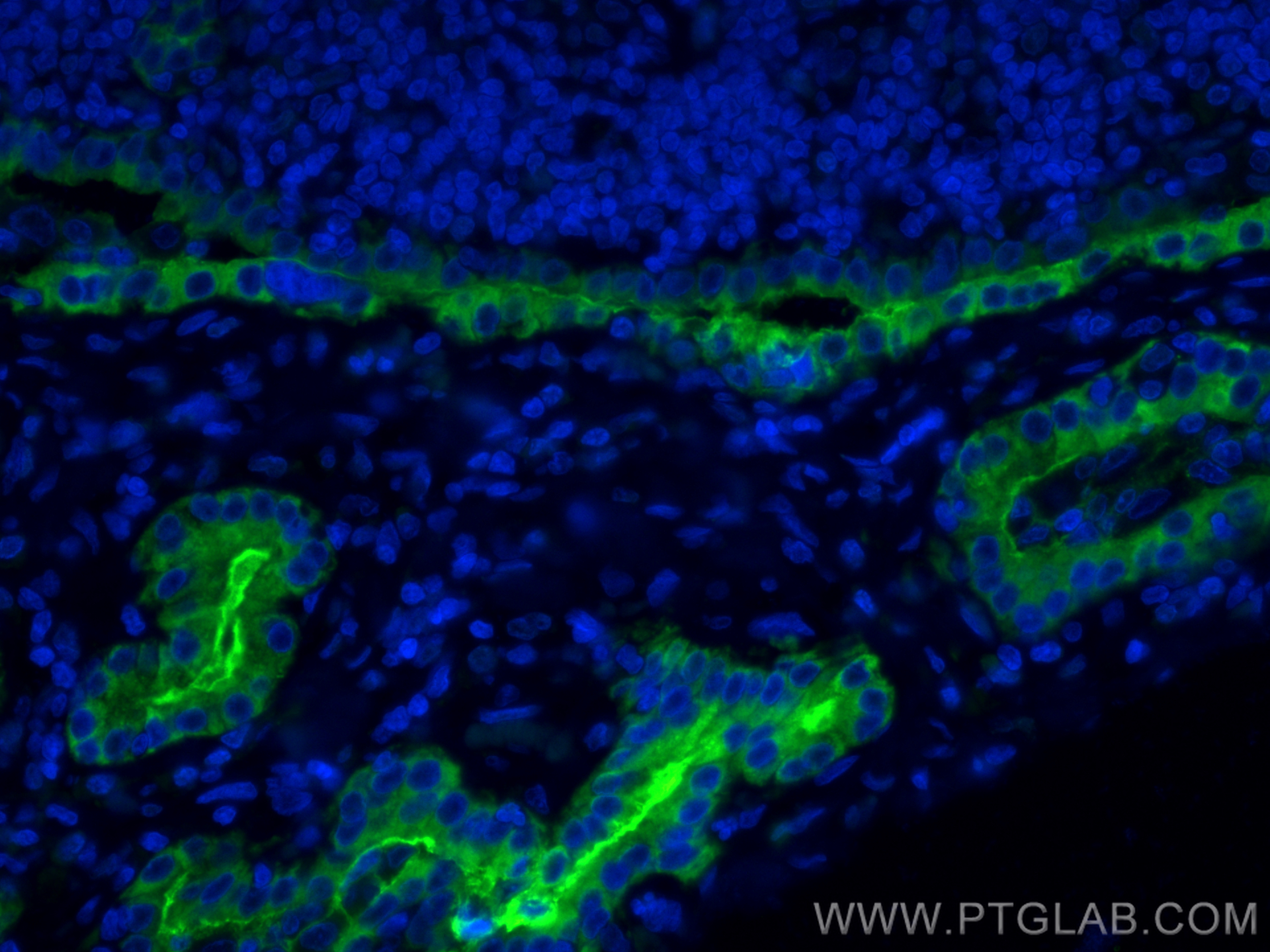 Immunofluorescence (IF) / fluorescent staining of human thyroid cancer tissue using CoraLite® Plus 488-conjugated Thyroglobulin Monocl (CL488-60272)