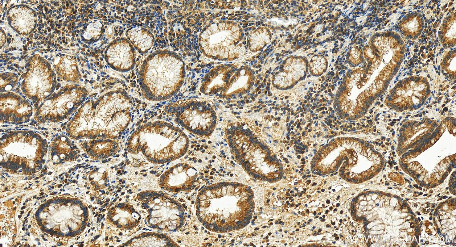 Immunohistochemistry (IHC) staining of human stomach cancer tissue using Tissue Factor Polyclonal antibody (28005-1-AP)