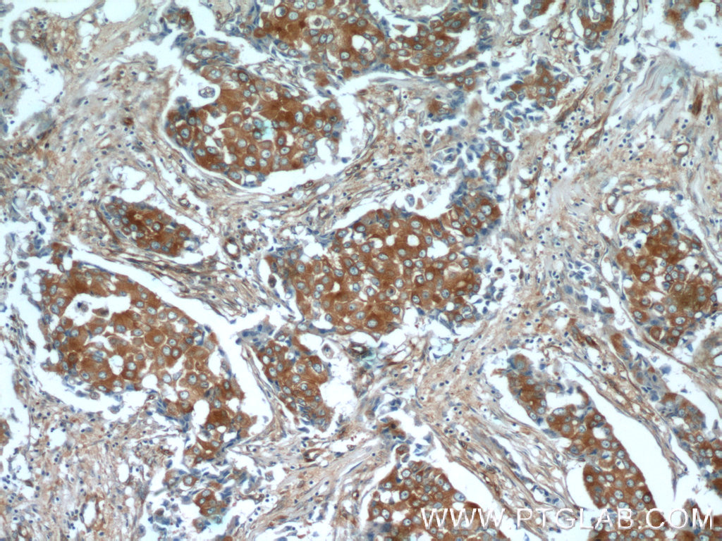 Immunohistochemistry (IHC) staining of human breast cancer tissue using Beta Tubulin Monoclonal antibody (66240-1-Ig)