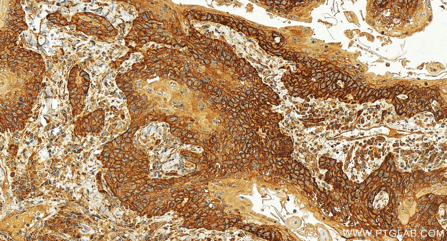 Immunohistochemistry (IHC) staining of human skin cancer tissue using Tyrosinase Polyclonal antibody (31291-1-AP)