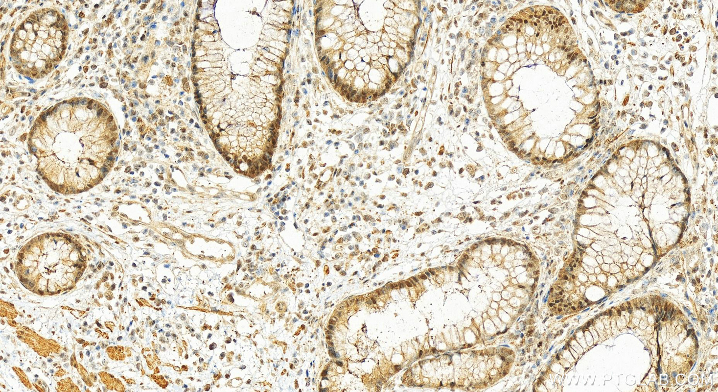 Immunohistochemistry (IHC) staining of human colon cancer tissue using UBE1 Polyclonal antibody (15912-1-AP)