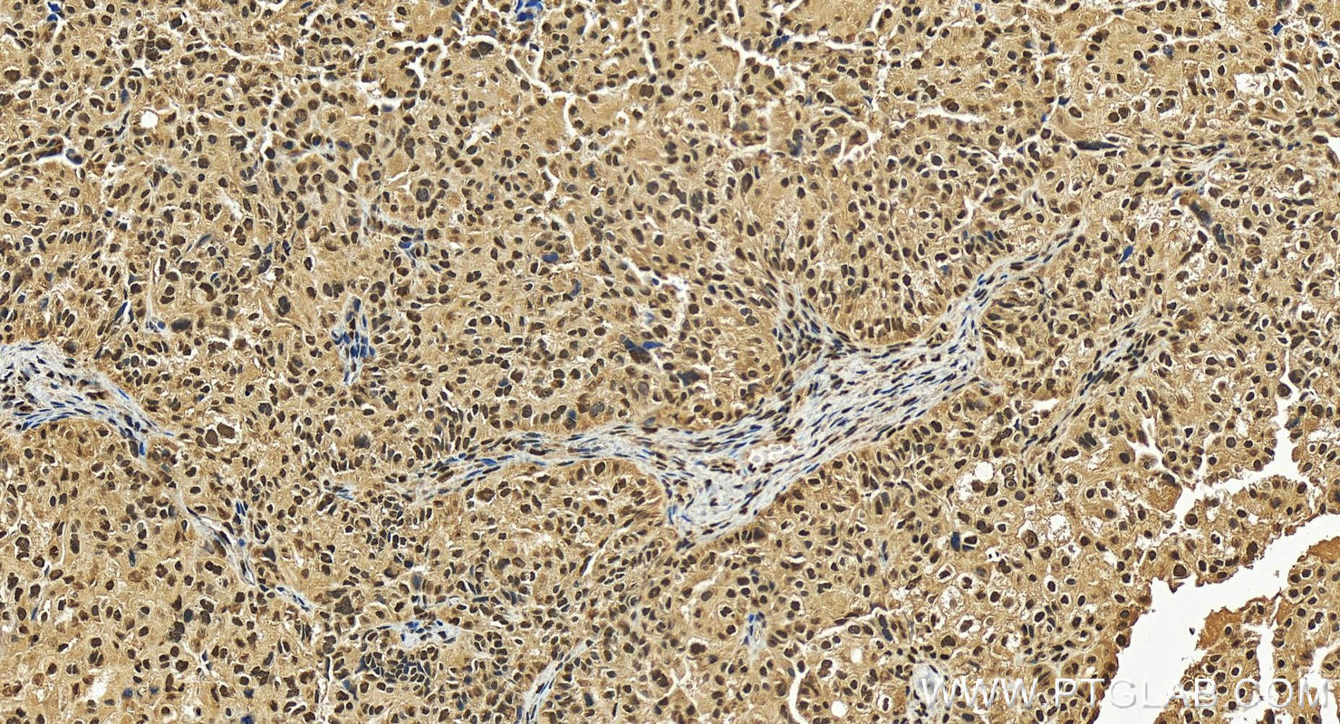 Immunohistochemistry (IHC) staining of human ovary cancer tissue using UBLCP1 Polyclonal antibody (12099-1-AP)