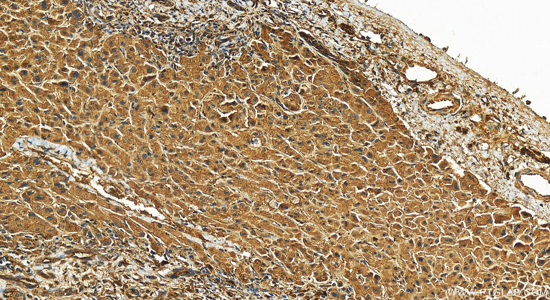 Immunohistochemistry (IHC) staining of human intrahepatic cholangiocarcinoma tissue using UCH-L1/PGP9.5 Polyclonal antibody (14730-1-AP)