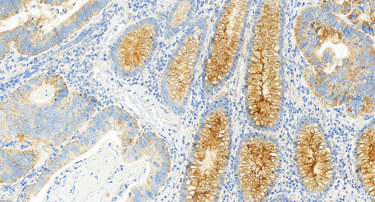 Immunohistochemistry (IHC) staining of human colon cancer tissue using ULBP2 Recombinant antibody (83709-1-RR)