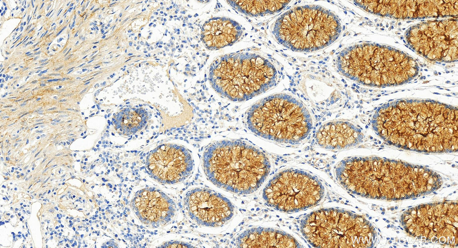 Immunohistochemistry (IHC) staining of human colon cancer tissue using ULBP2 Recombinant antibody (83709-1-RR)