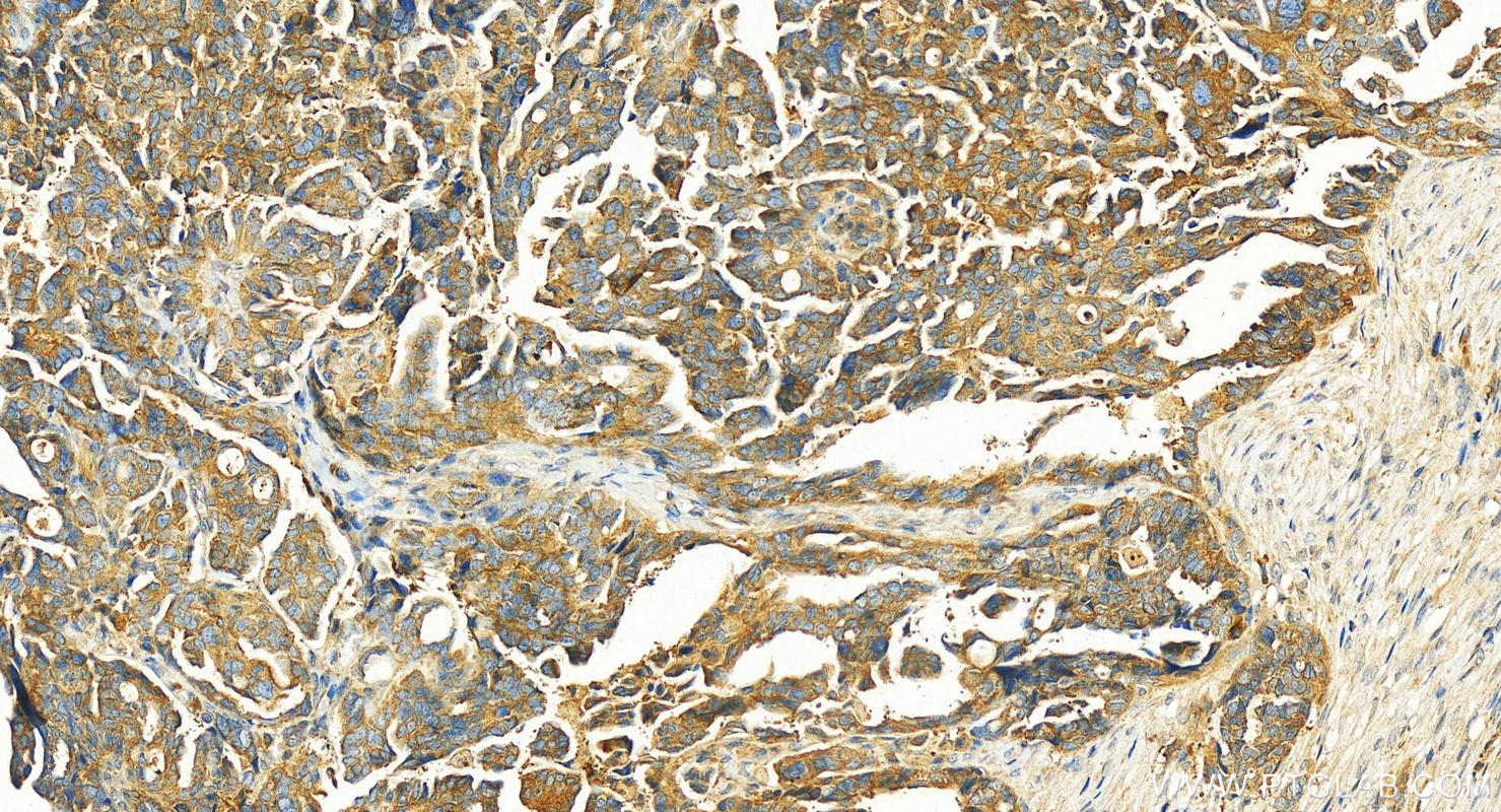 Immunohistochemistry (IHC) staining of human ovary cancer tissue using UNC45A Polyclonal antibody (19564-1-AP)