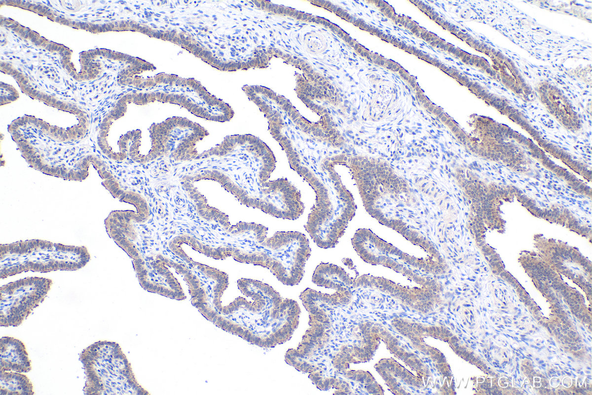 Immunohistochemistry (IHC) staining of human ovary tumor tissue using UPF3B Polyclonal antibody (23301-1-AP)