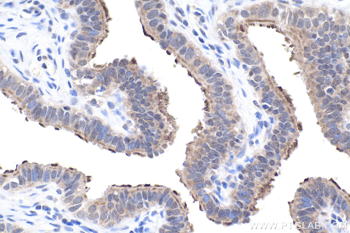 Immunohistochemistry (IHC) staining of human ovary tumor tissue using UPF3B Polyclonal antibody (23301-1-AP)