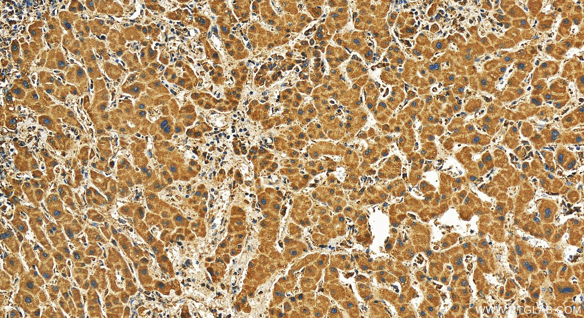 Immunohistochemistry (IHC) staining of human intrahepatic cholangiocarcinoma tissue using UQCC Polyclonal antibody (28114-1-AP)