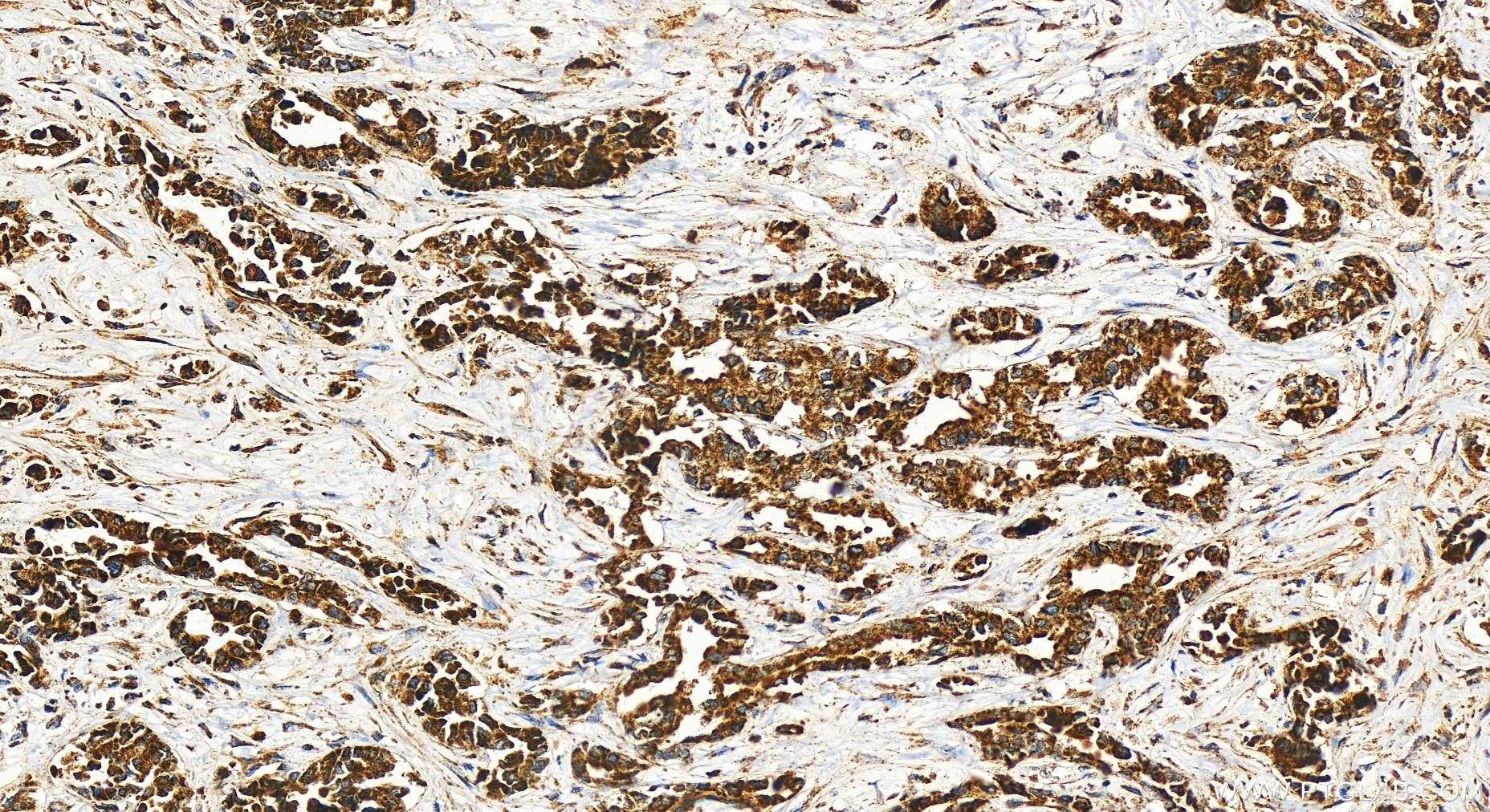 Immunohistochemistry (IHC) staining of human intrahepatic cholangiocarcinoma tissue using UQCC Polyclonal antibody (28114-1-AP)