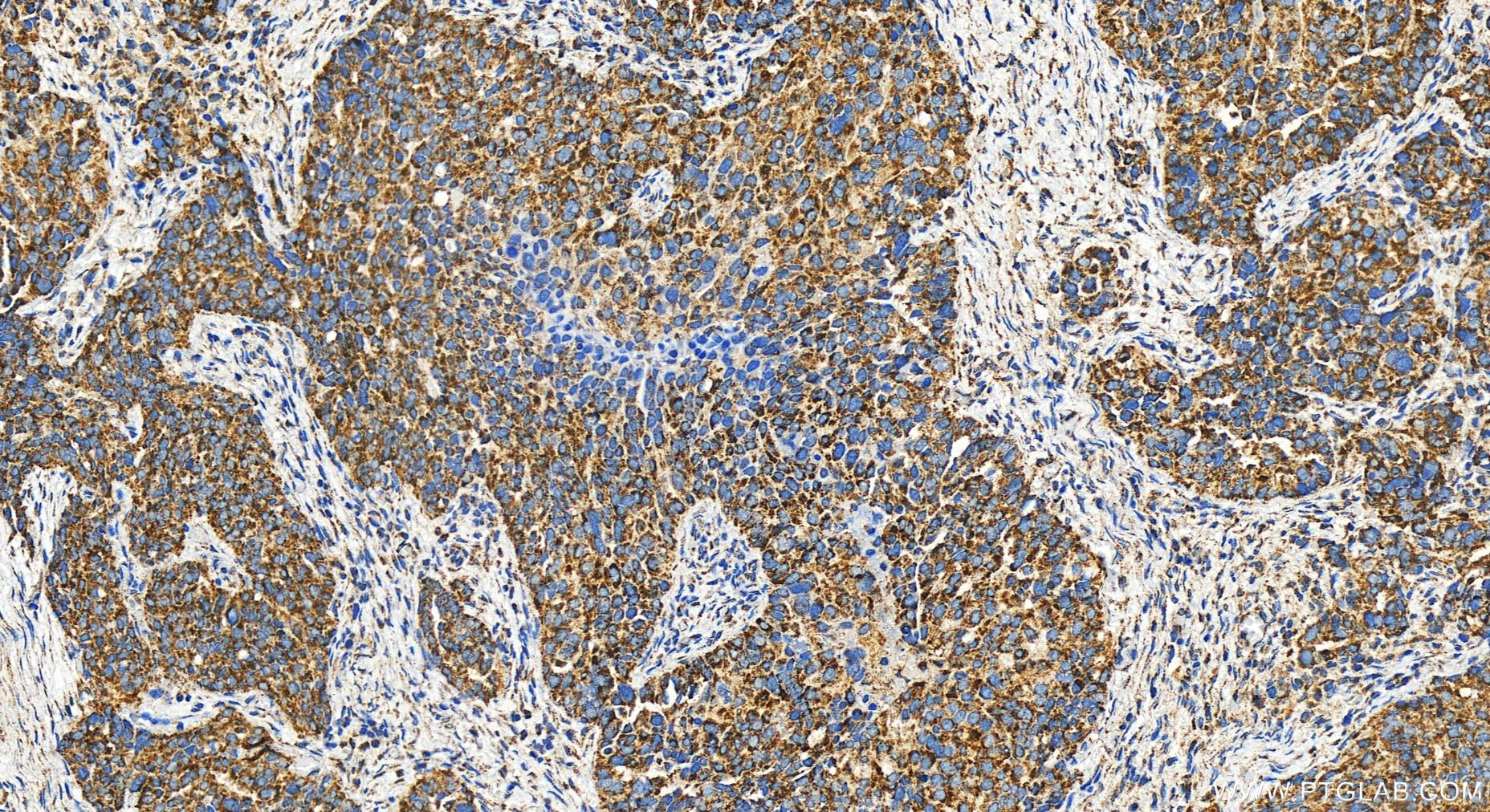 Immunohistochemistry (IHC) staining of human ovary cancer tissue using UQCC Polyclonal antibody (28114-1-AP)