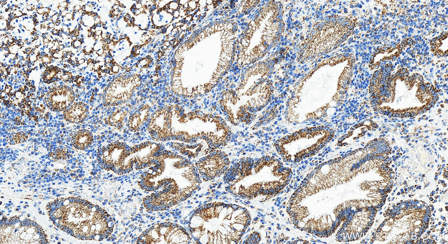 Immunohistochemistry (IHC) staining of human stomach cancer tissue using UQCRC1 Recombinant antibody (83671-2-RR)