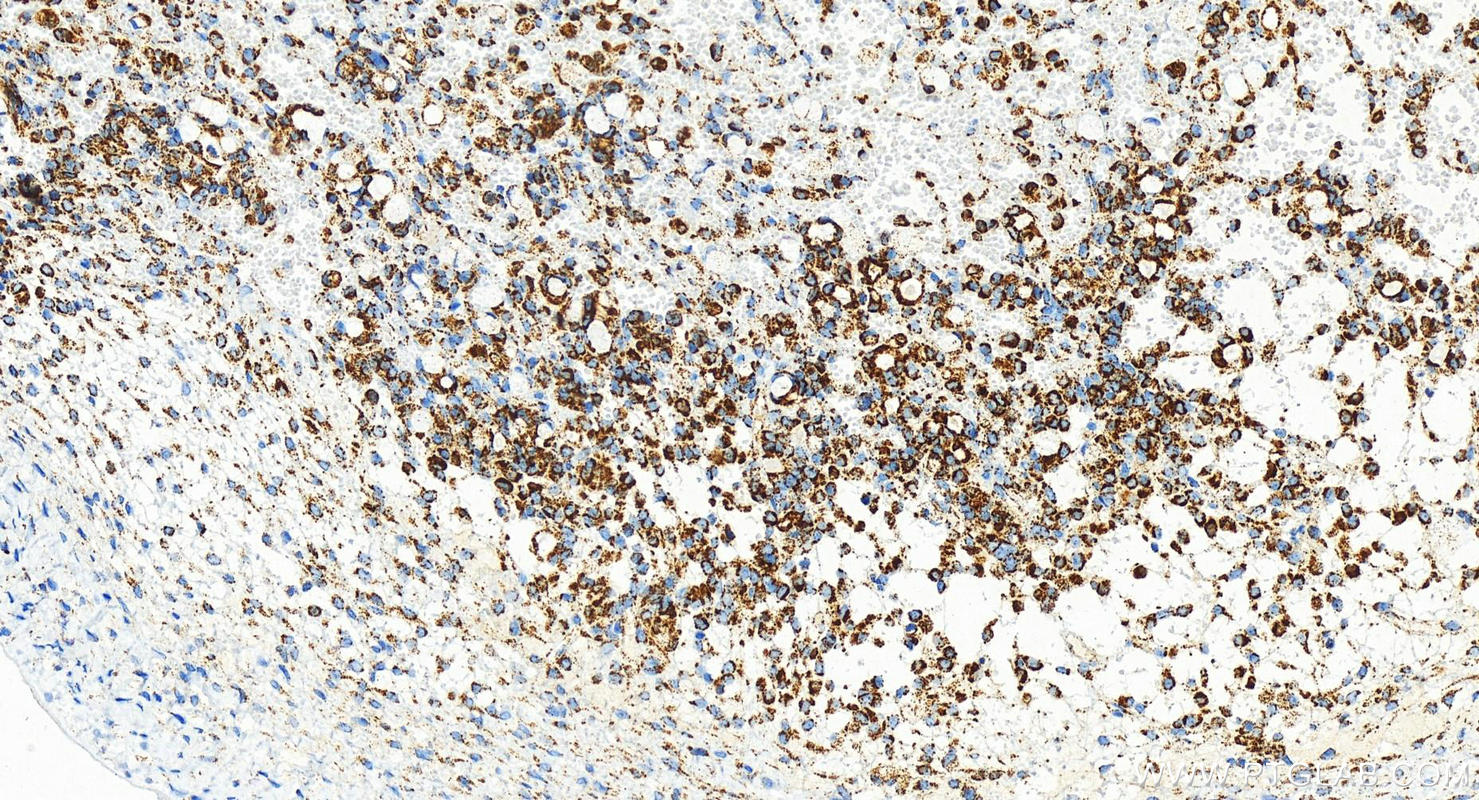 Immunohistochemistry (IHC) staining of human ovary cancer tissue using UQCRC1 Recombinant antibody (83671-2-RR)