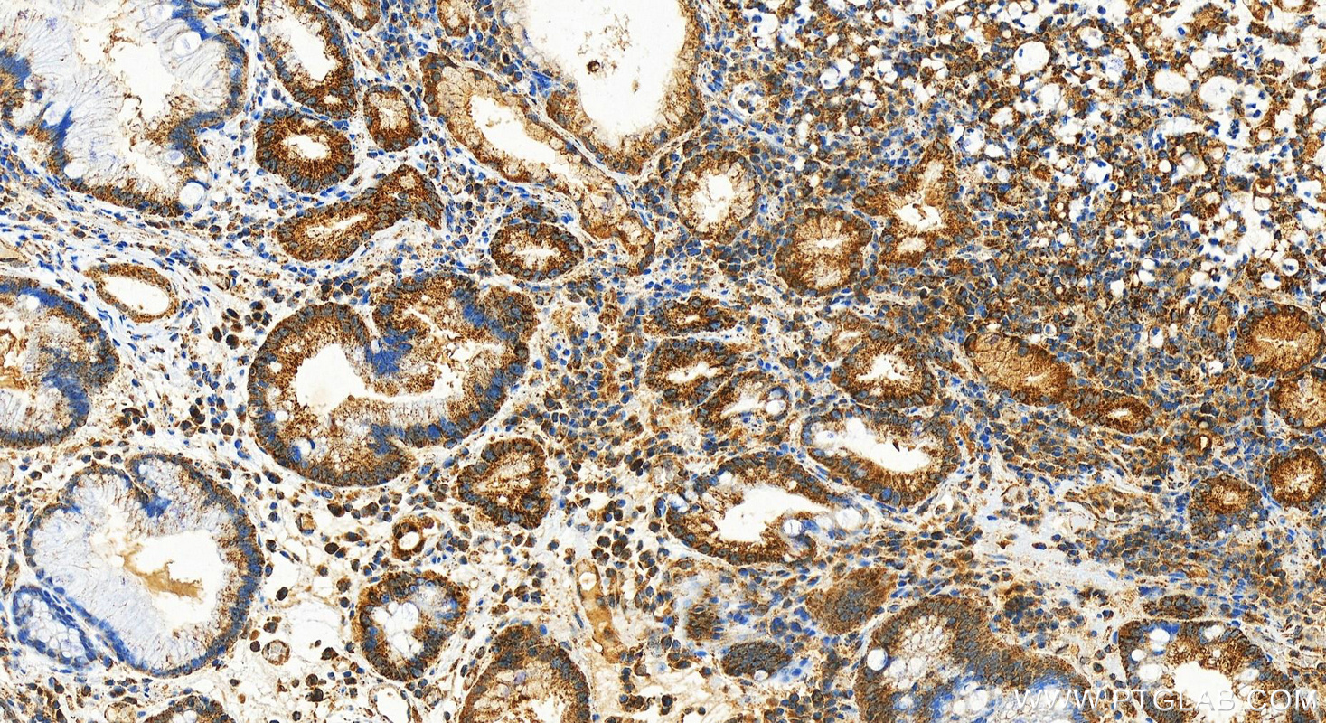 Immunohistochemistry (IHC) staining of human stomach cancer tissue using UQCRC2 Recombinant antibody (83667-2-RR)