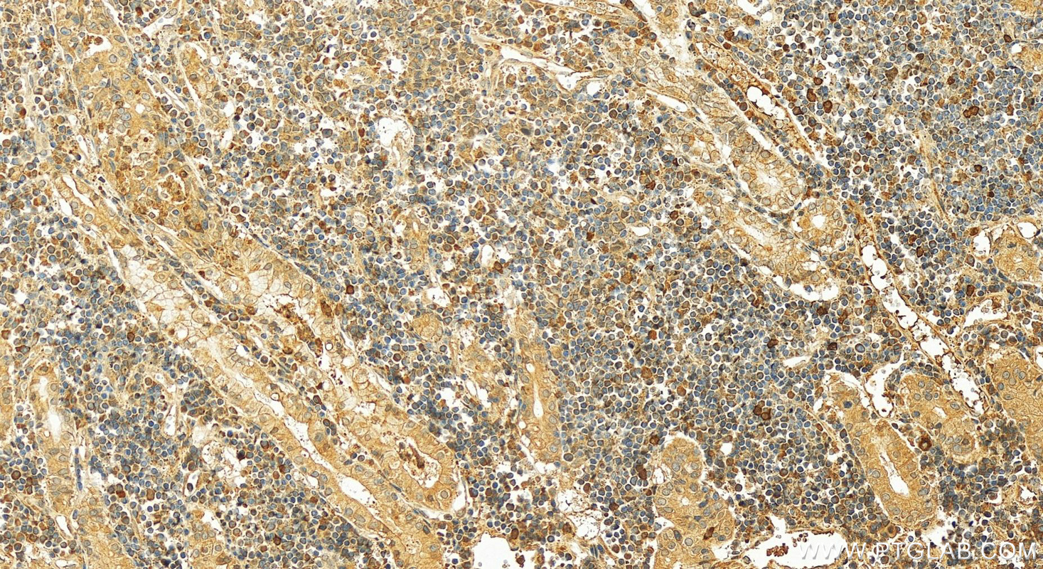 Immunohistochemistry (IHC) staining of human stomach cancer tissue using URG4 Polyclonal antibody (11998-1-AP)