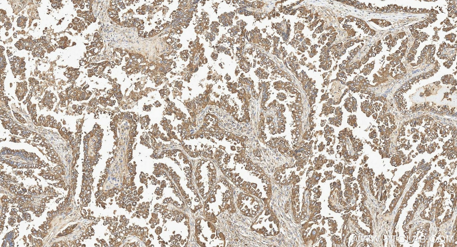 Immunohistochemistry (IHC) staining of human lung cancer tissue using p115, USO1 Polyclonal antibody (13509-1-AP)
