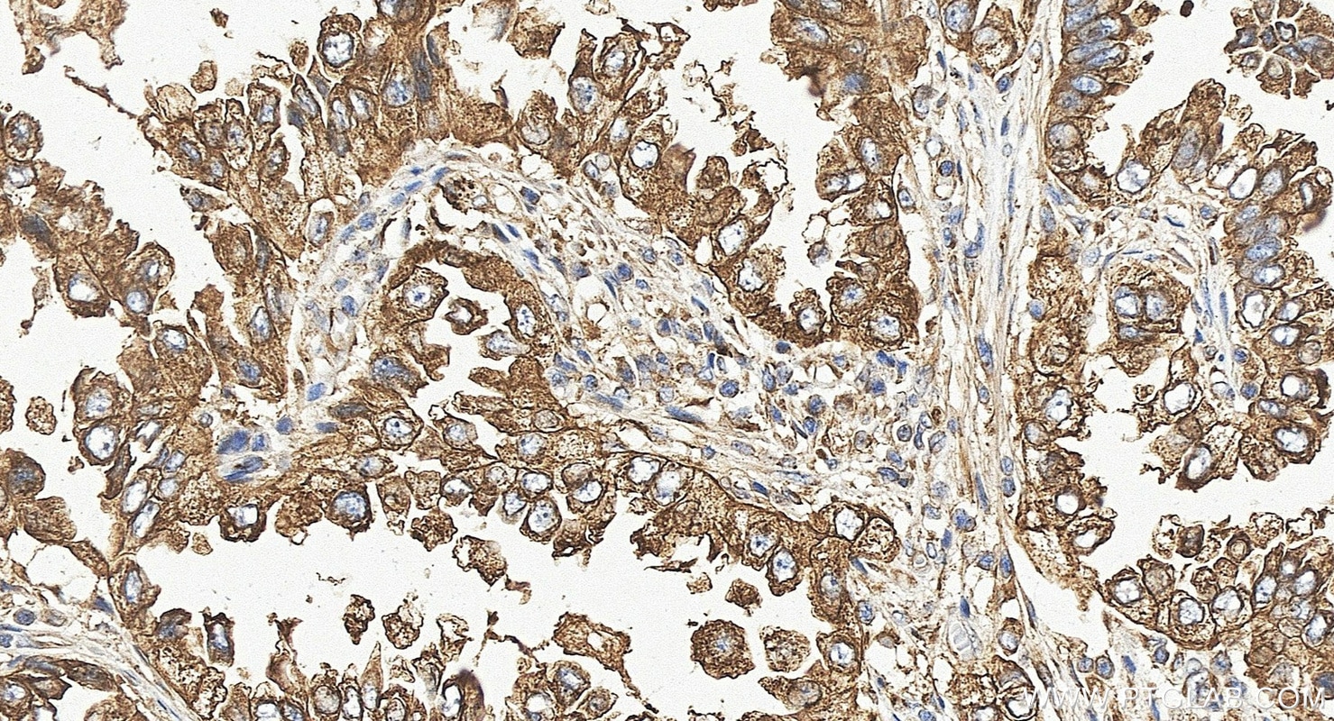 Immunohistochemistry (IHC) staining of human lung cancer tissue using p115, USO1 Polyclonal antibody (13509-1-AP)