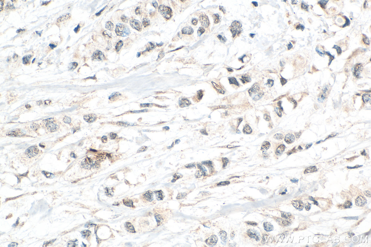 Immunohistochemistry (IHC) staining of human breast cancer tissue using USP10 Polyclonal antibody (19374-1-AP)