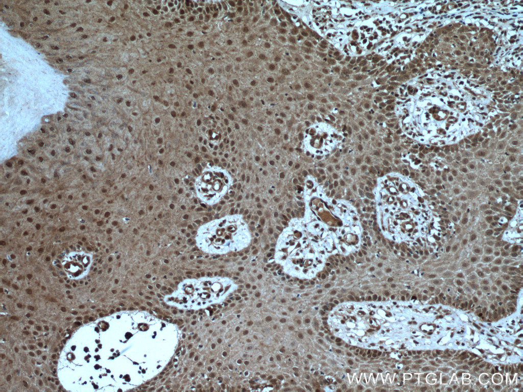 Immunohistochemistry (IHC) staining of human skin cancer tissue using USP13 Polyclonal antibody (16840-1-AP)