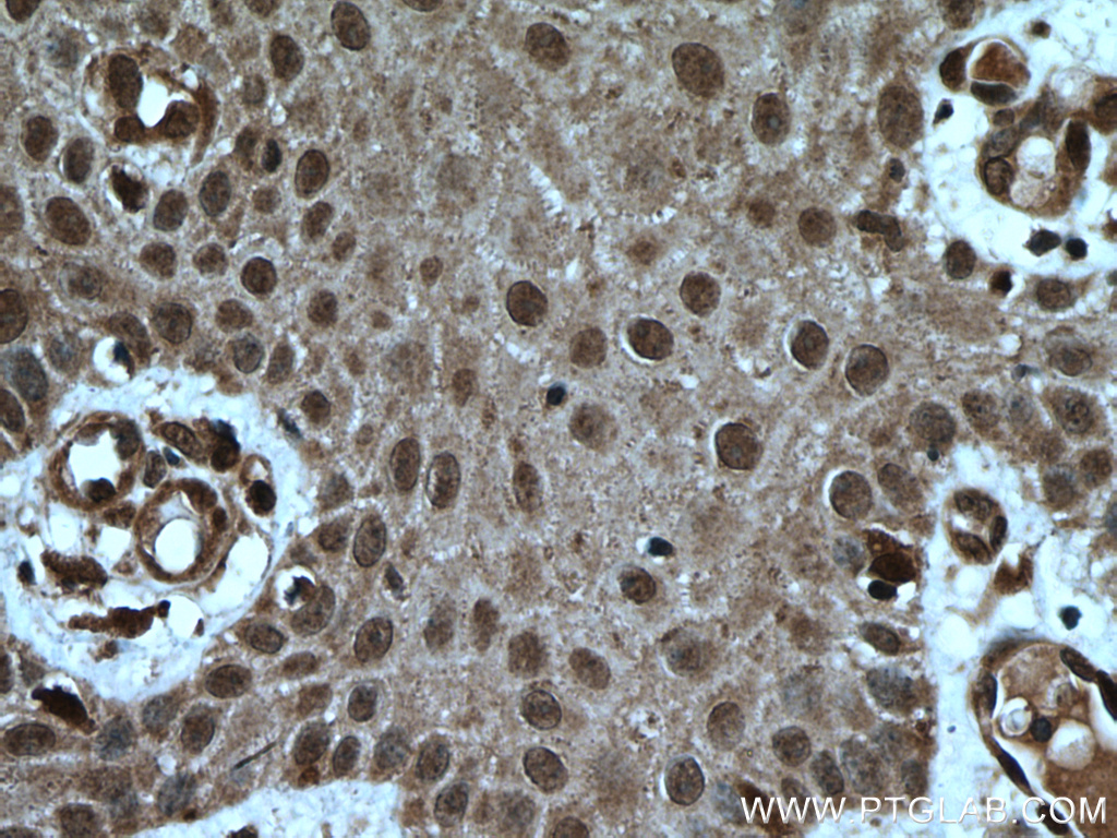 Immunohistochemistry (IHC) staining of human skin cancer tissue using USP13 Polyclonal antibody (16840-1-AP)