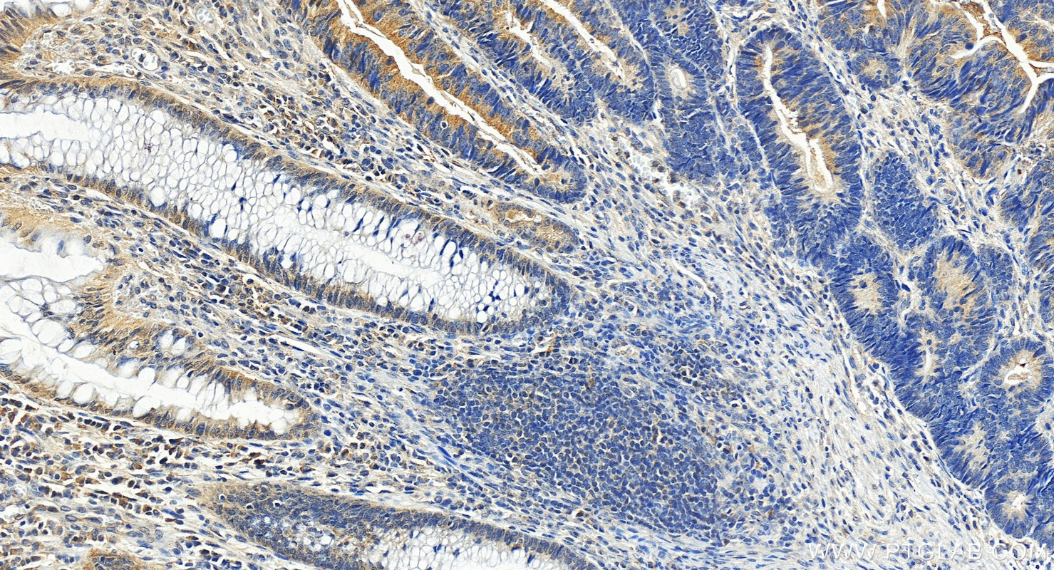 Immunohistochemistry (IHC) staining of human colon cancer tissue using USP18 Polyclonal antibody (12153-1-AP)