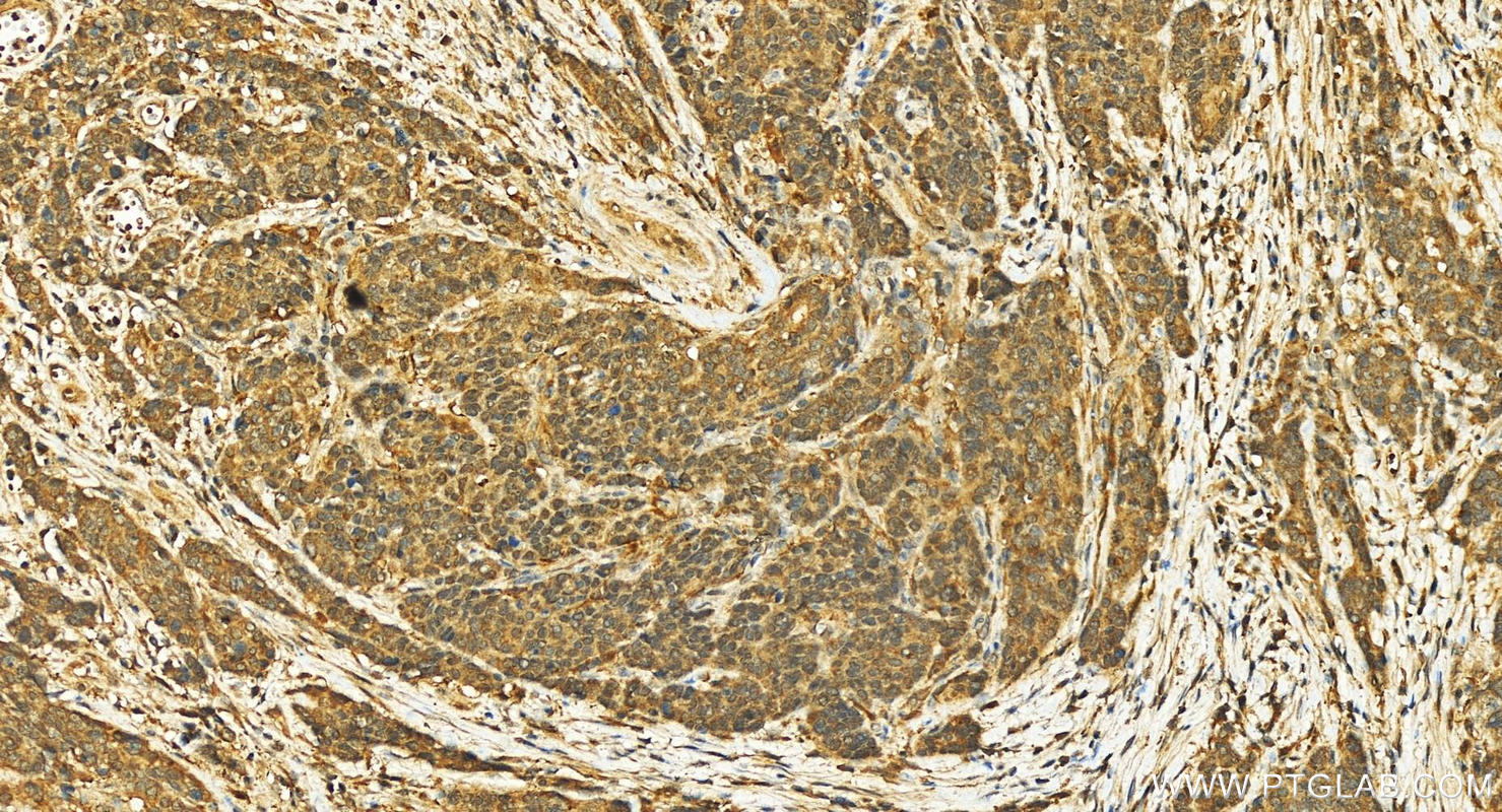 Immunohistochemistry (IHC) staining of human stomach cancer tissue using USP3 Polyclonal antibody (12490-1-AP)