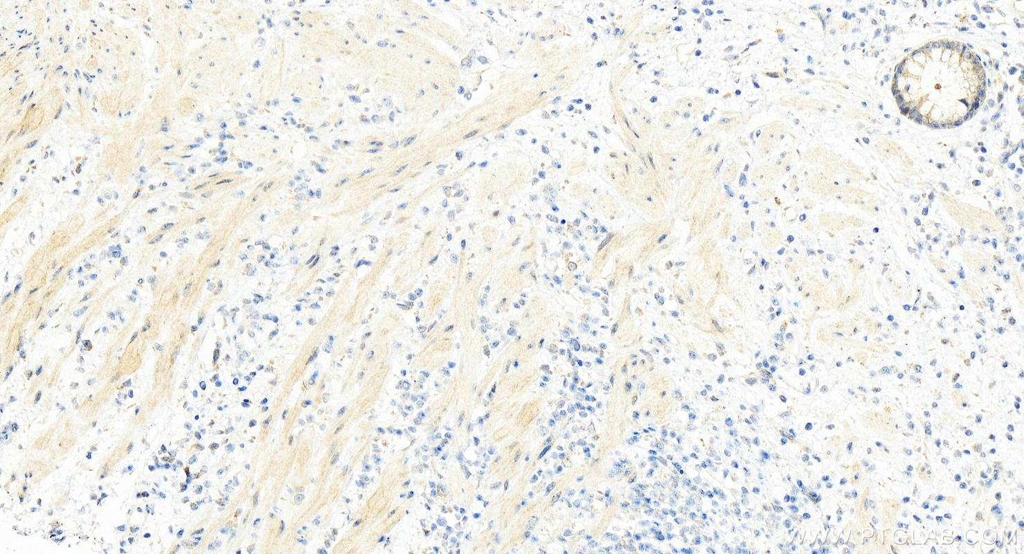 Immunohistochemistry (IHC) staining of human colon cancer tissue using USP30 Polyclonal antibody (15402-1-AP)