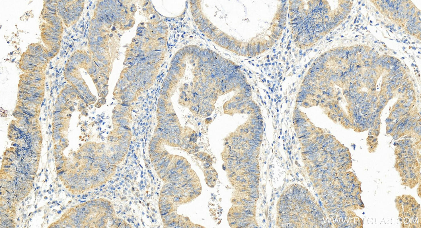 Immunohistochemistry (IHC) staining of human colon cancer tissue using USP30 Polyclonal antibody (15402-1-AP)