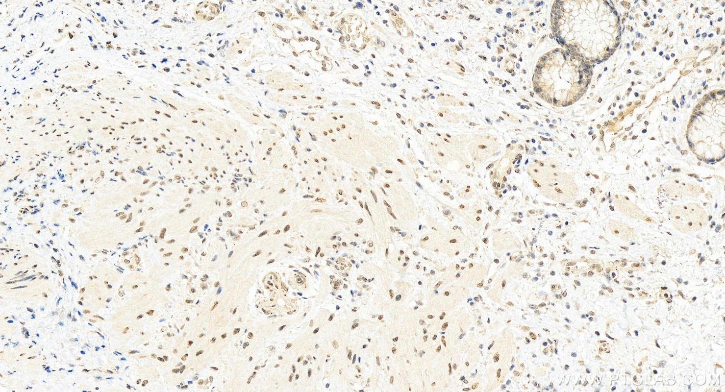 Immunohistochemistry (IHC) staining of human colon cancer tissue using USP35 Polyclonal antibody (24559-1-AP)