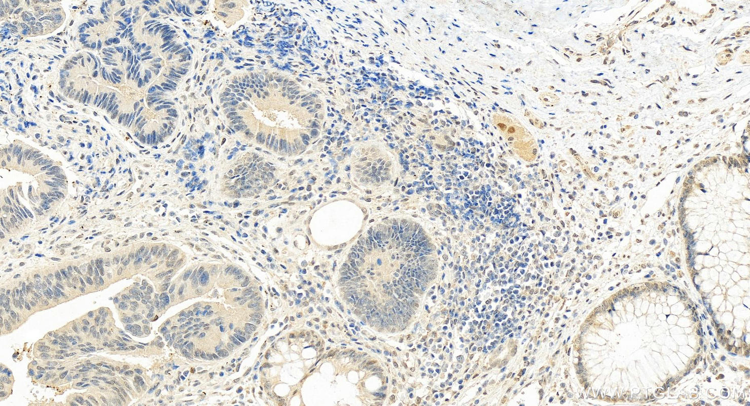 Immunohistochemistry (IHC) staining of human colon cancer tissue using USP35 Polyclonal antibody (24559-1-AP)