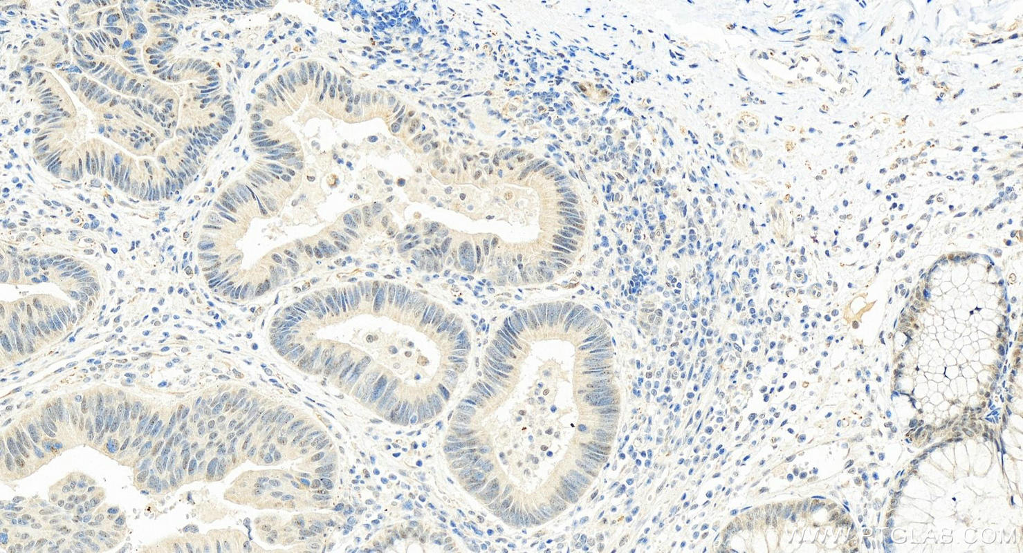 Immunohistochemistry (IHC) staining of human colon cancer tissue using USP39 Polyclonal antibody (23865-1-AP)