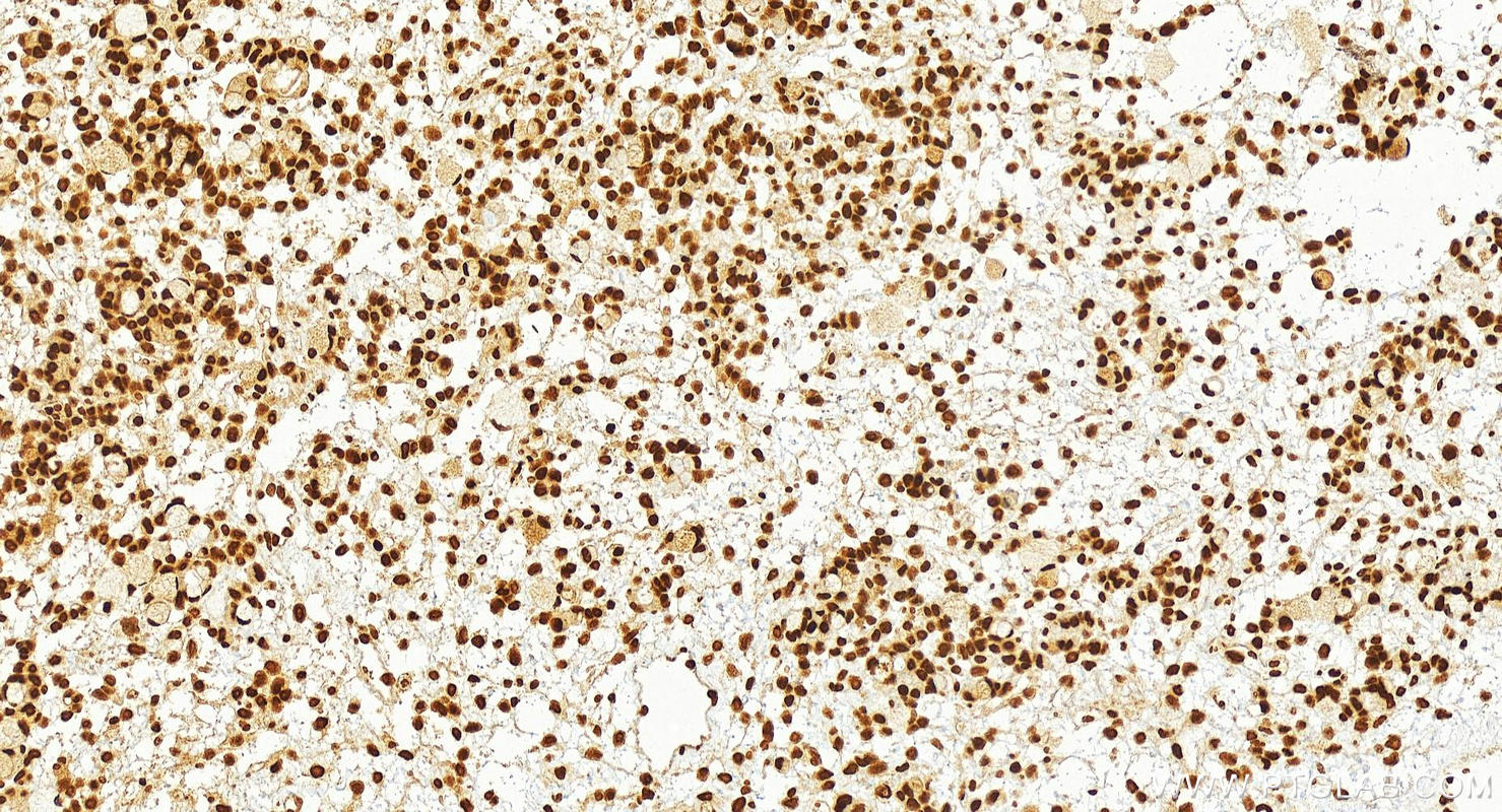 Immunohistochemistry (IHC) staining of human ovary cancer tissue using USP4 Recombinant antibody (83734-2-RR)