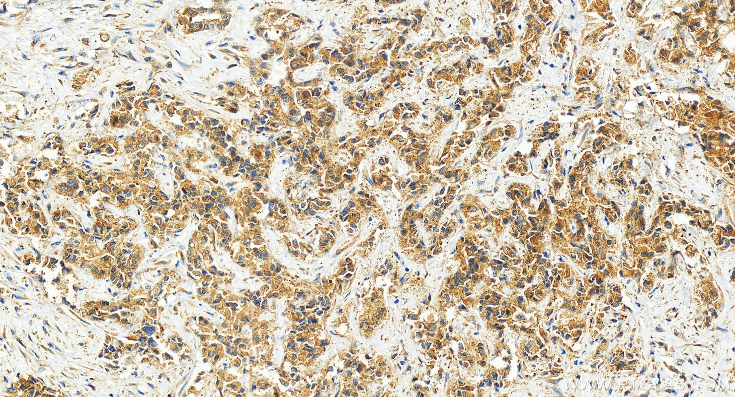 Immunohistochemistry (IHC) staining of human intrahepatic cholangiocarcinoma tissue using USP40 Polyclonal antibody (27217-1-AP)