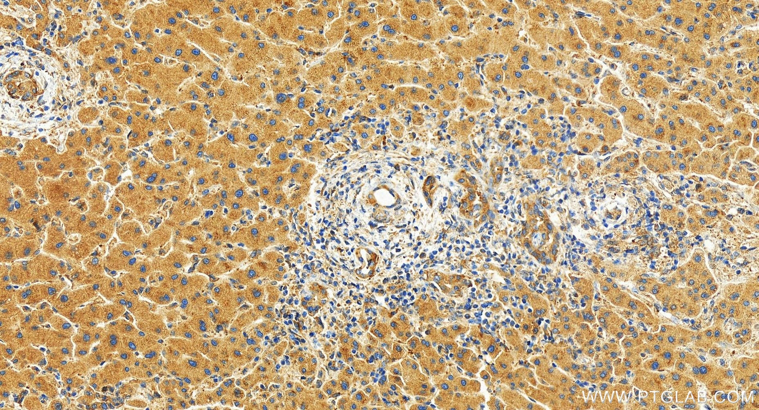 Immunohistochemistry (IHC) staining of human intrahepatic cholangiocarcinoma tissue using USP40 Polyclonal antibody (27217-1-AP)