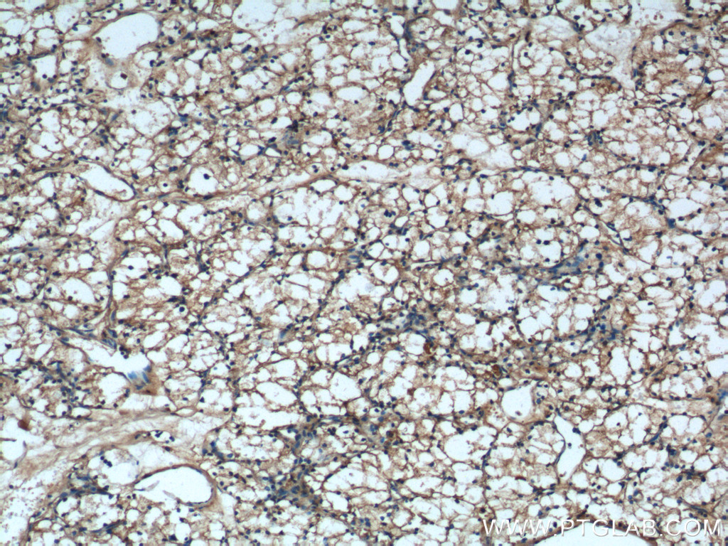 Immunohistochemistry (IHC) staining of human renal cell carcinoma tissue using USP46 Polyclonal antibody (13502-1-AP)