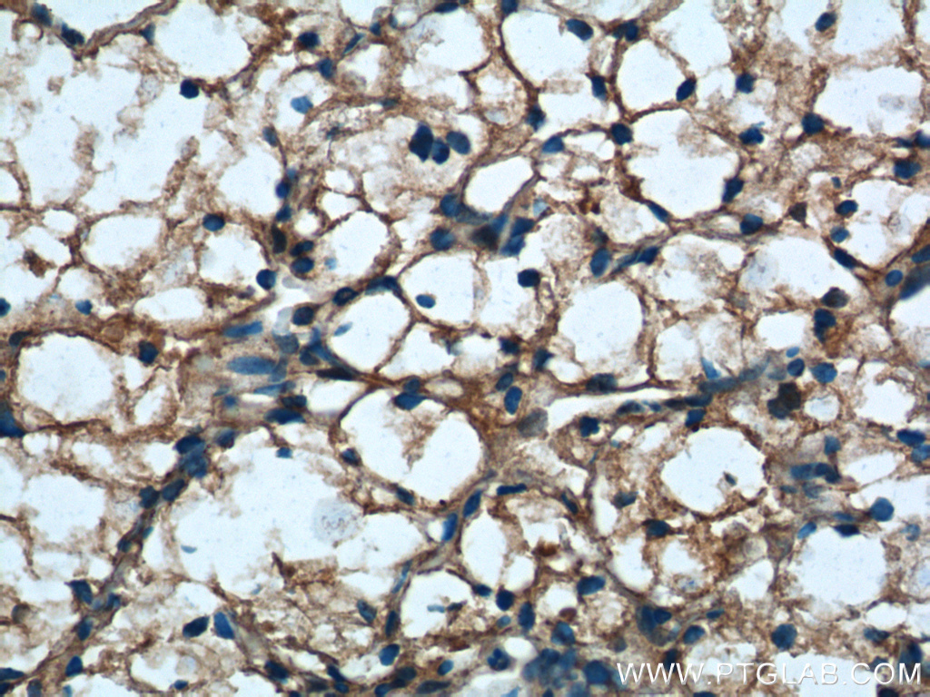 Immunohistochemistry (IHC) staining of human renal cell carcinoma tissue using USP46 Polyclonal antibody (13502-1-AP)