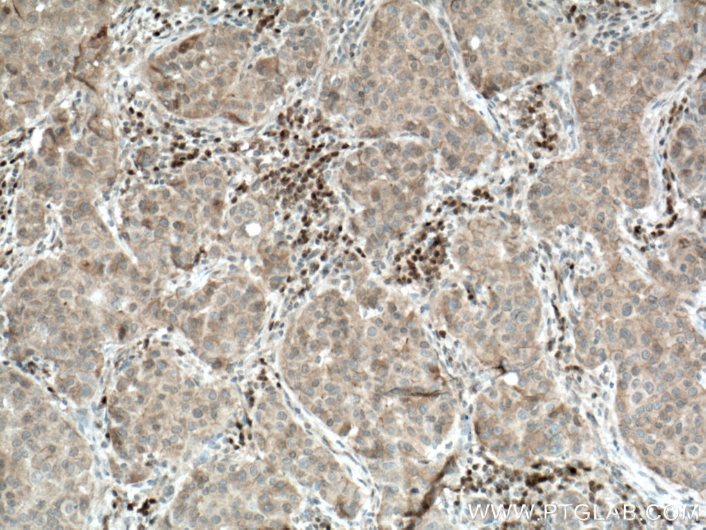 Immunohistochemistry (IHC) staining of human breast cancer tissue using USP49 Polyclonal antibody (18066-1-AP)